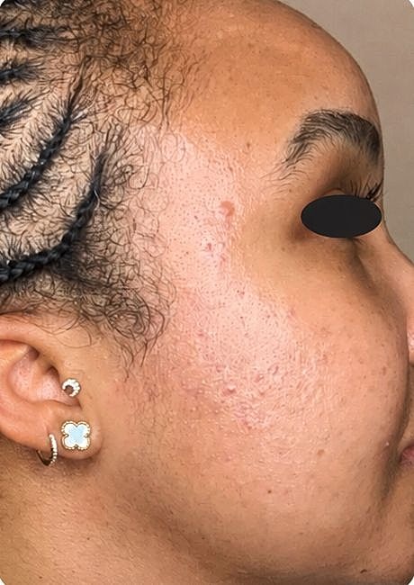 Chemical Peels Before & After