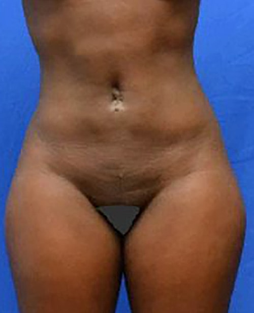Liposuction Before & After