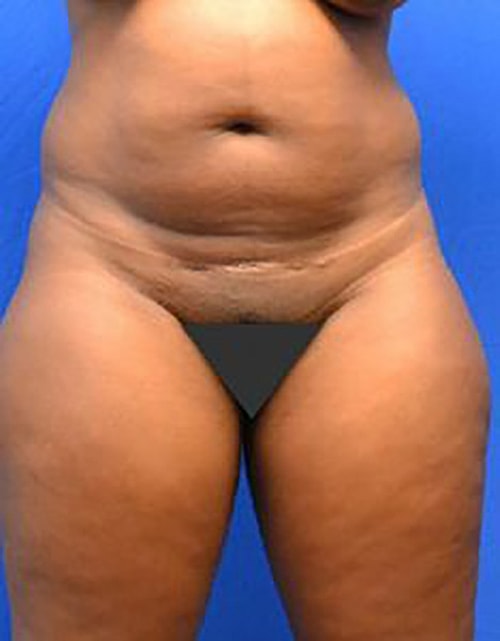 Liposuction Before & After