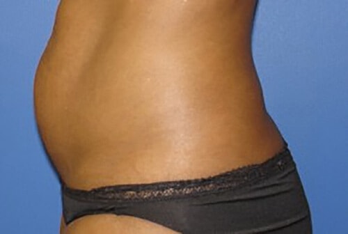Liposuction Before & After