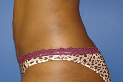 Liposuction Before & After