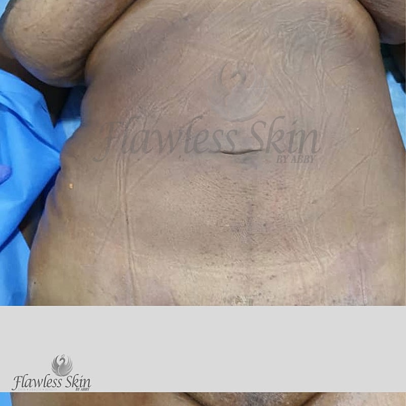 Liposuction Before & After