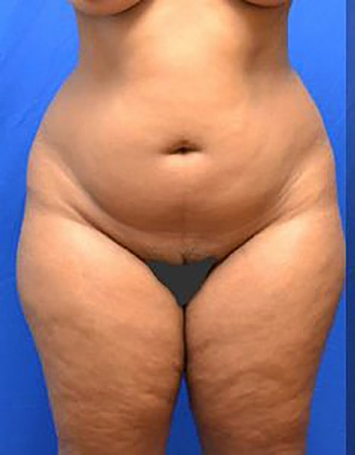 Liposuction Before & After