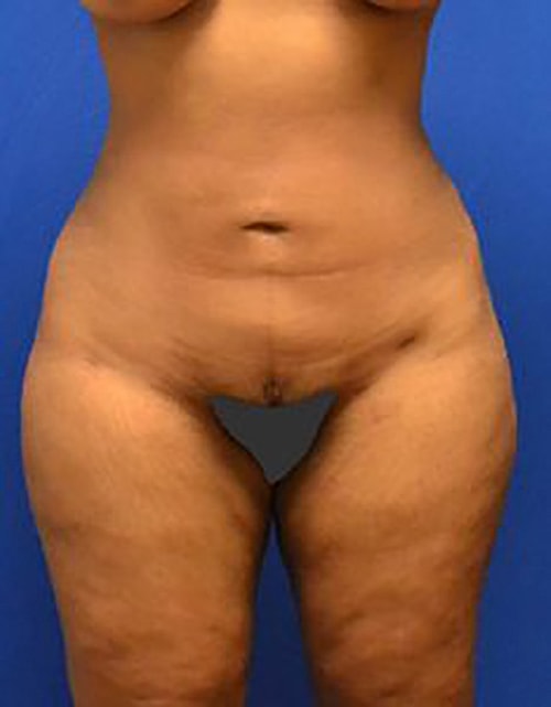 Liposuction Before & After