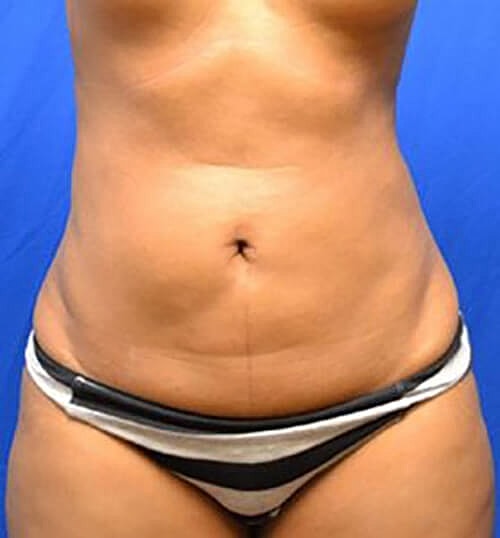Liposuction Before & After