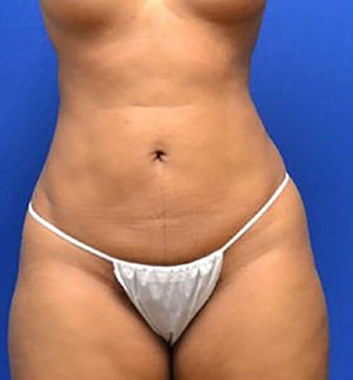 Liposuction Before & After