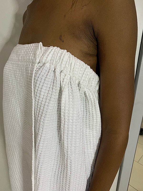 Liposuction Before & After