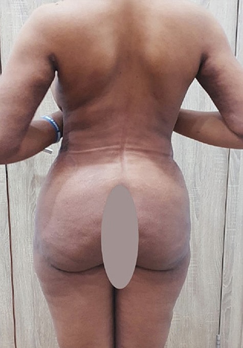 Liposuction Before & After