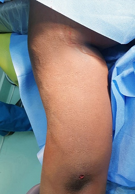 Liposuction Before & After