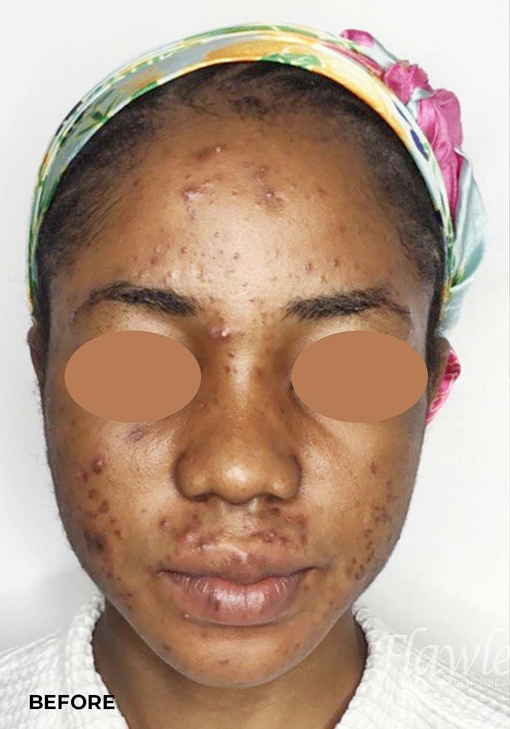 Acne Facial Procedure Before & After