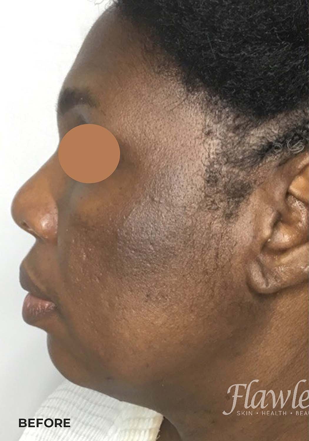 Acne Facial Procedure Before & After