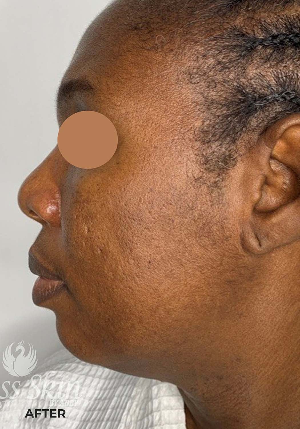 Acne Facial Procedure Before & After