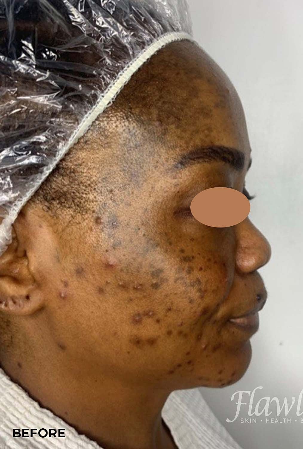 Acne Facial Procedure Before & After