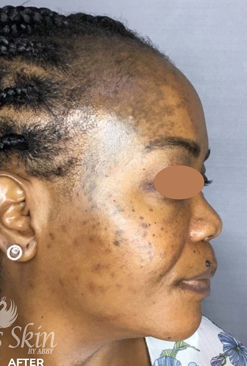 Acne Facial Procedure Before & After