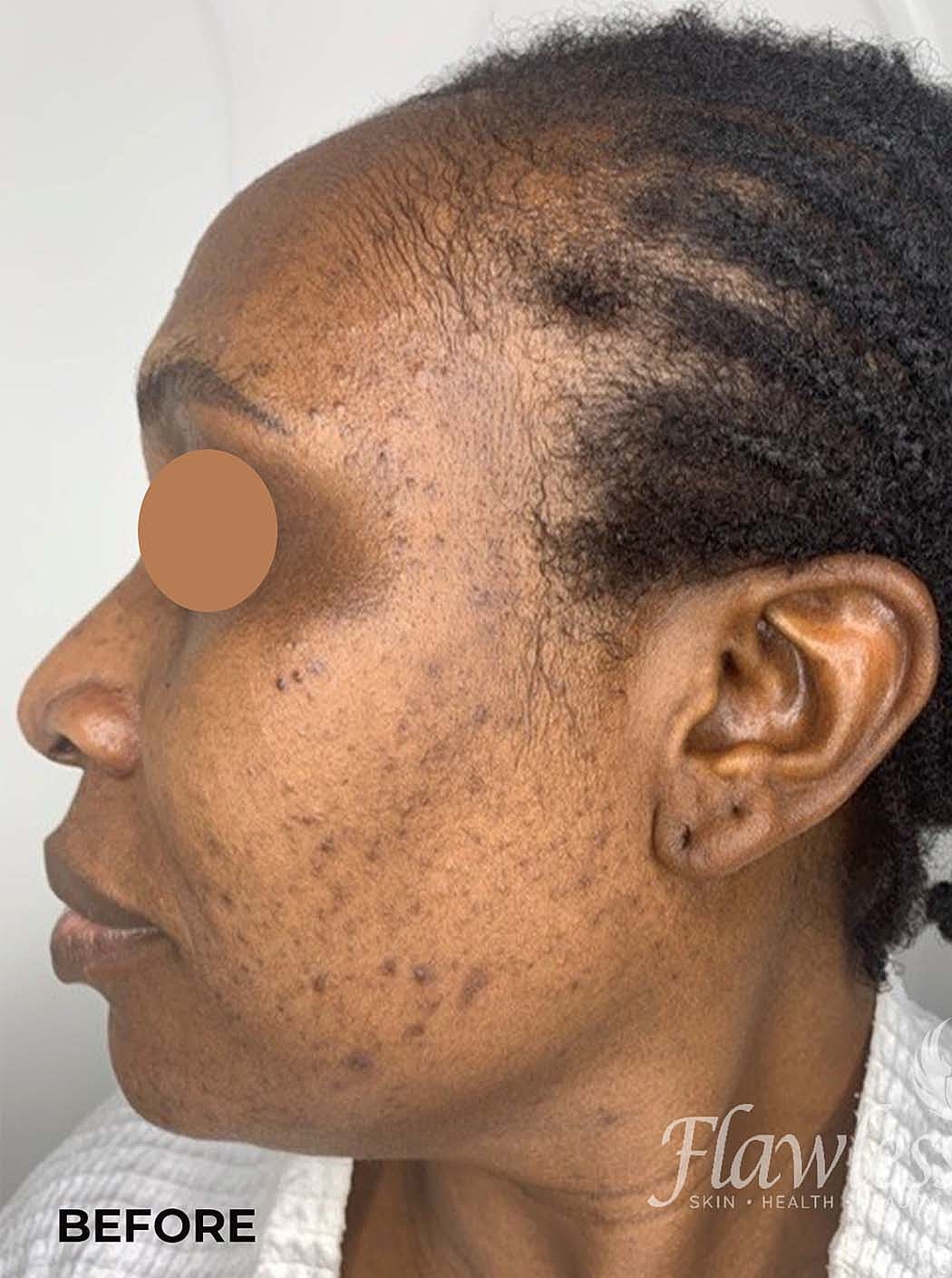Acne Facial Procedure Before & After