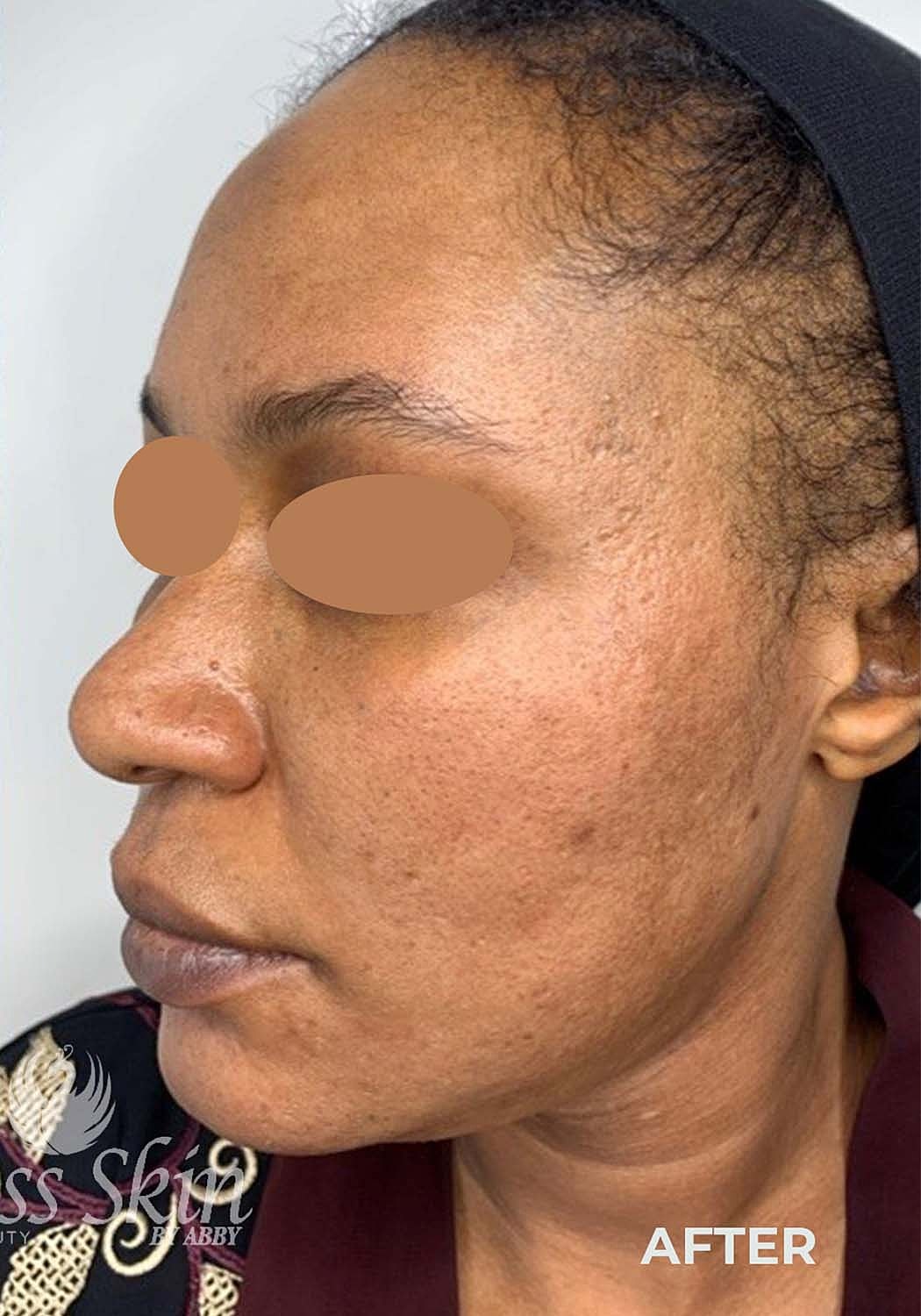 Acne Facial Procedure Before & After