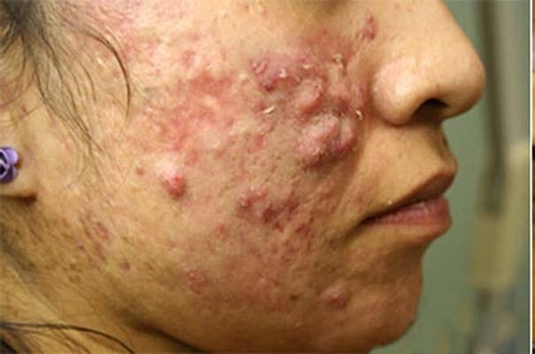 Acne Facial Procedure Before & After