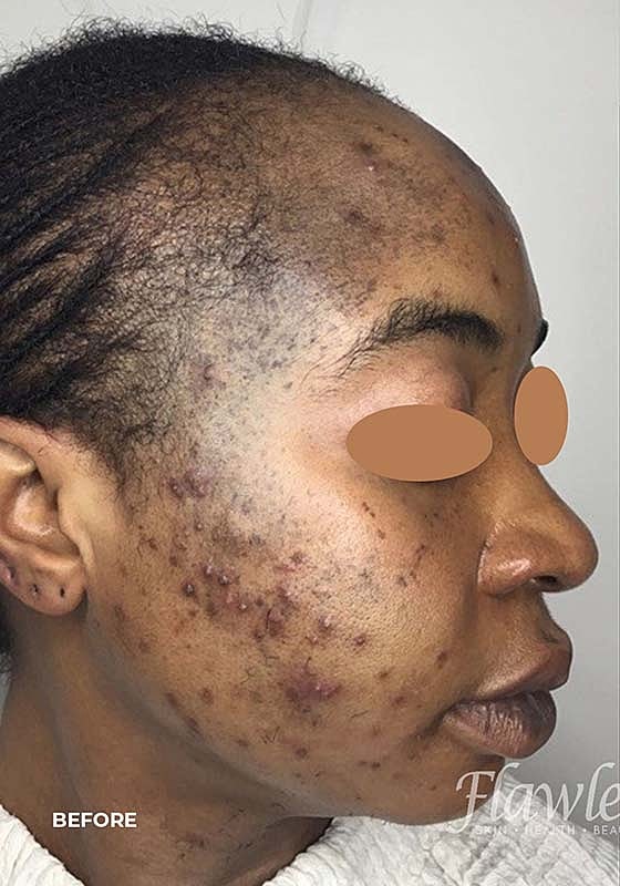 Acne Facial Procedure Before & After