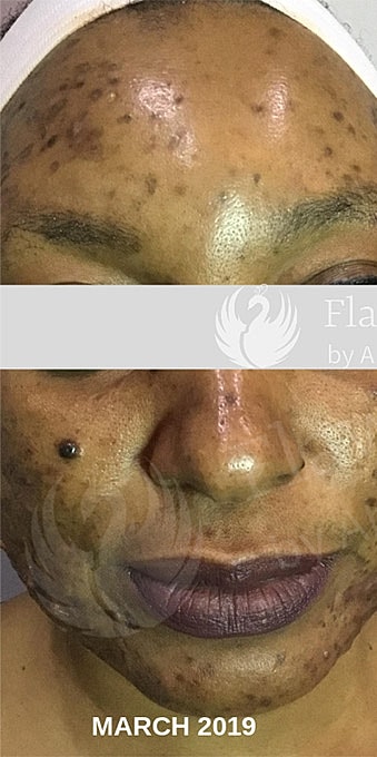 Acne Facial Procedure Before & After