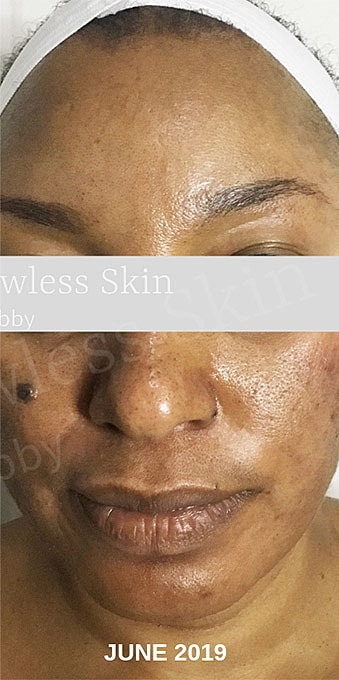 Acne Facial Procedure Before & After