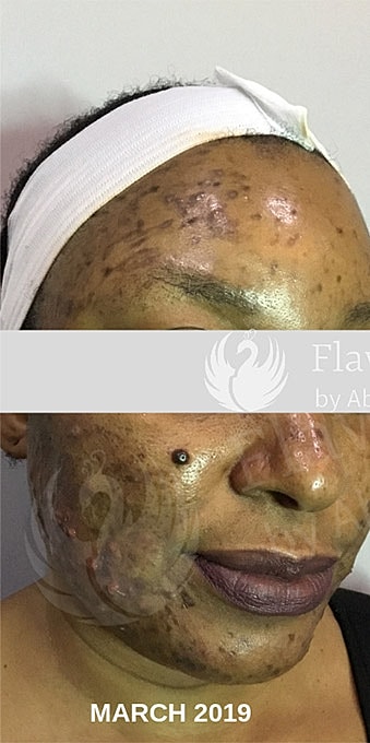 Acne Facial Procedure Before & After