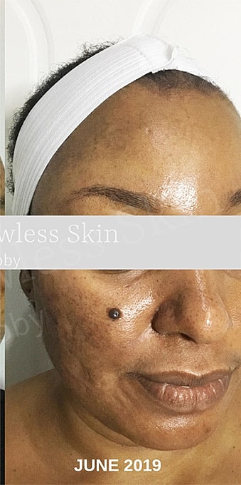 Acne Facial Procedure Before & After