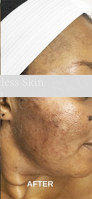 Acne Facial Procedure Before & After