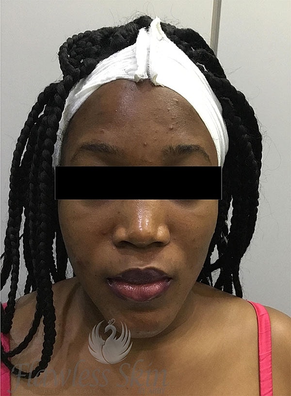 Acne Facial Procedure Before & After