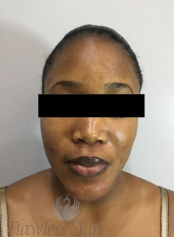 Acne Facial Procedure Before & After