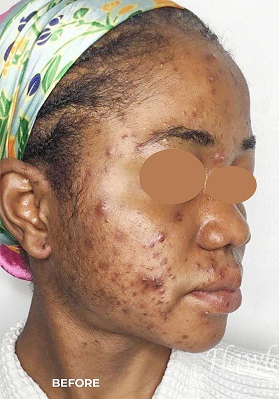Acne Facial Procedure Before & After