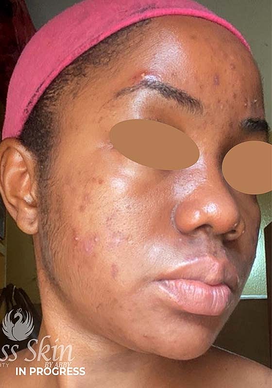 Acne Facial Procedure Before & After