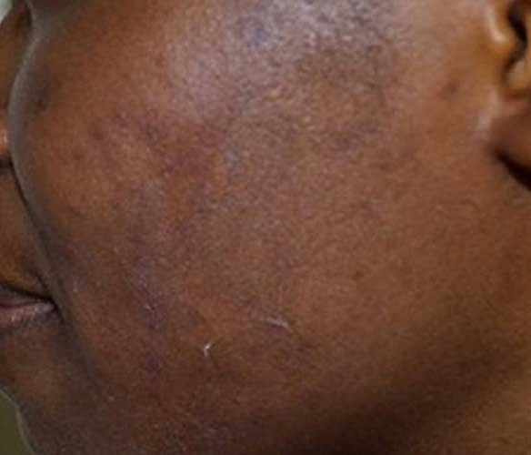 Acne Facial Procedure Before & After