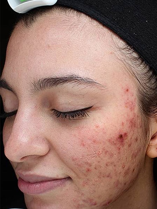 Acne Facial Procedure Before & After