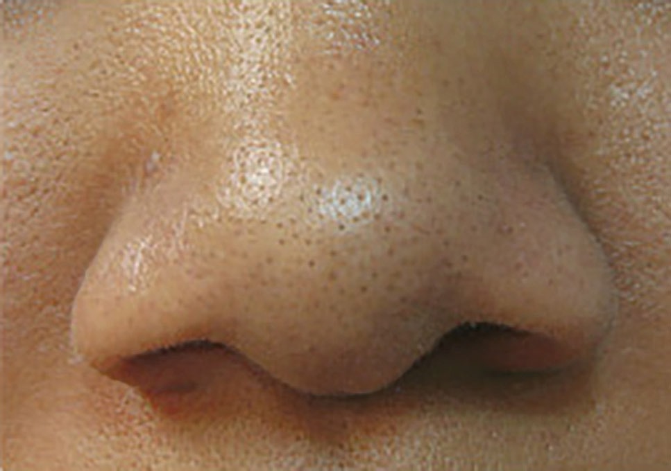 Acne Facial Procedure Before & After