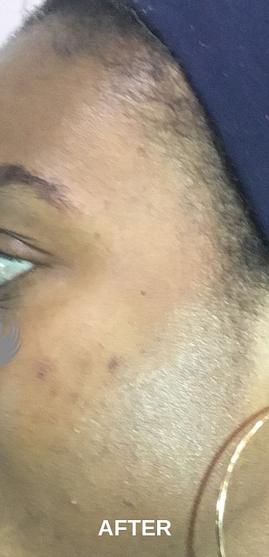 Acne Facial Procedure Before & After