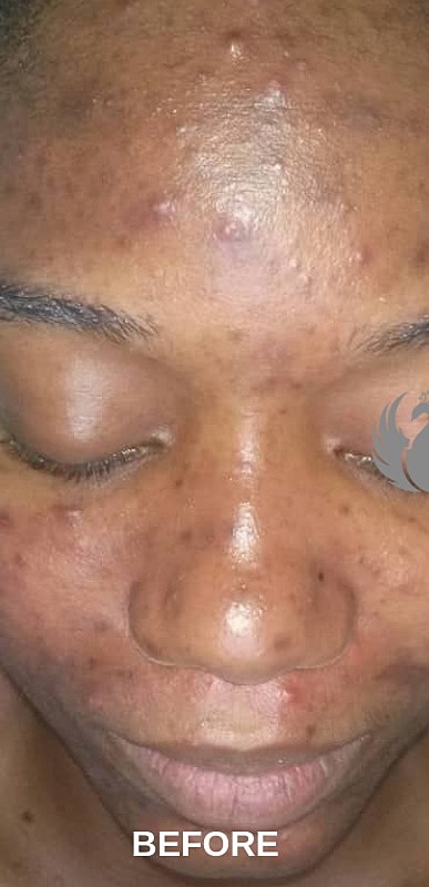 Acne Facial Procedure Before & After