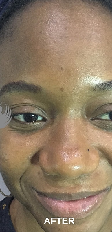 Acne Facial Procedure Before & After