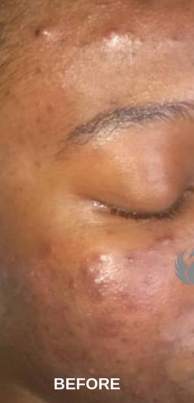 Acne Facial Procedure Before & After