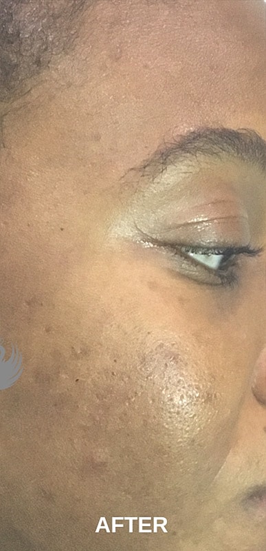 Acne Facial Procedure Before & After