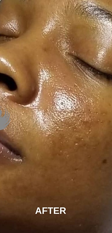 Acne Facial Procedure Before & After