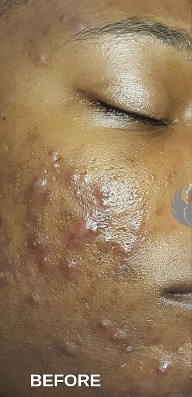Acne Facial Procedure Before & After