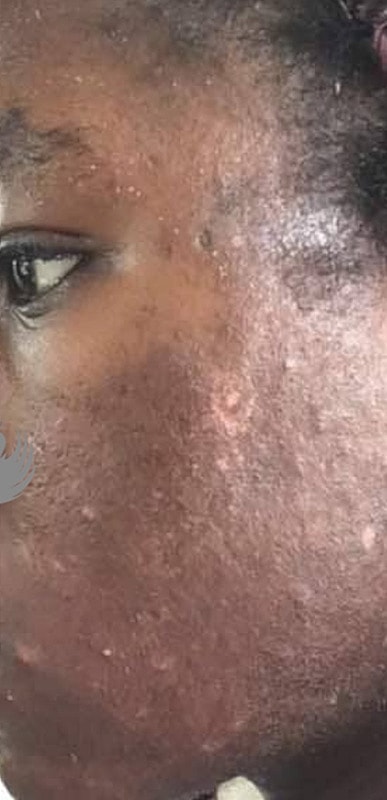 Acne Facial Procedure Before & After