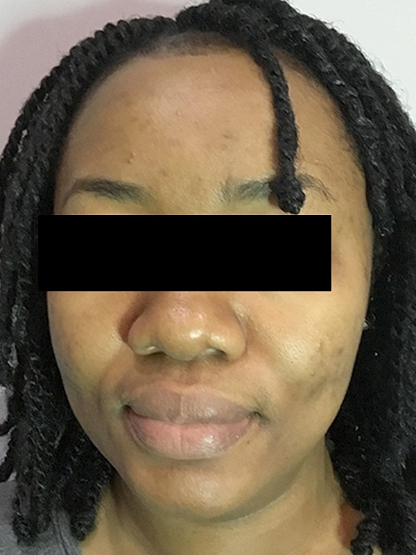Acne Facial Procedure Before & After