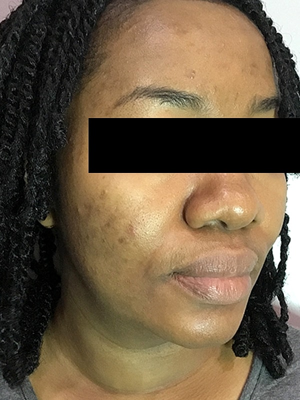 Acne Facial Procedure Before & After