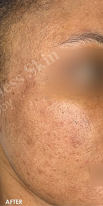 Acne Facial Procedure Before & After