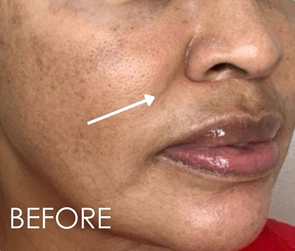 PDO Thread Lift Before & After