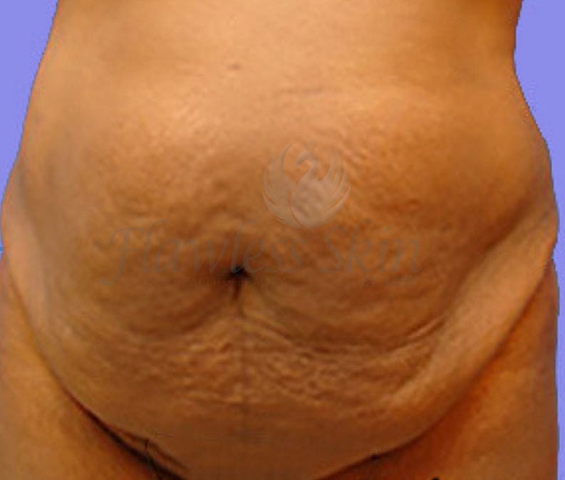 Mommy Makeover Before & After