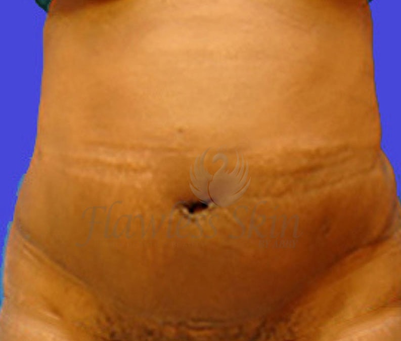 Mommy Makeover Before & After