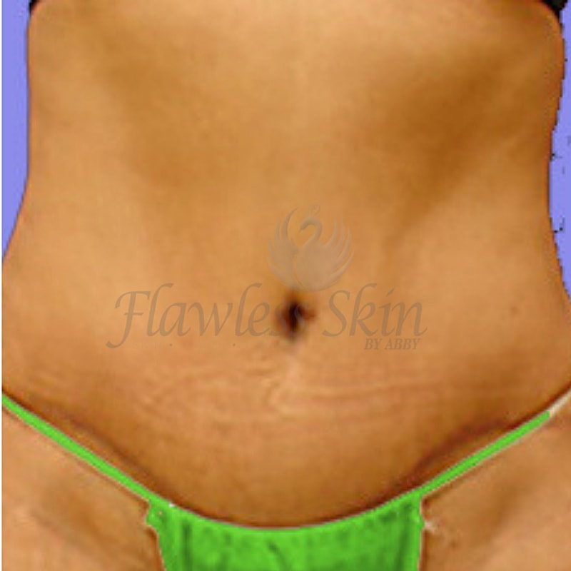 Tummy Tuck Before & After