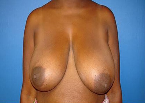 Breast Reduction Before & After